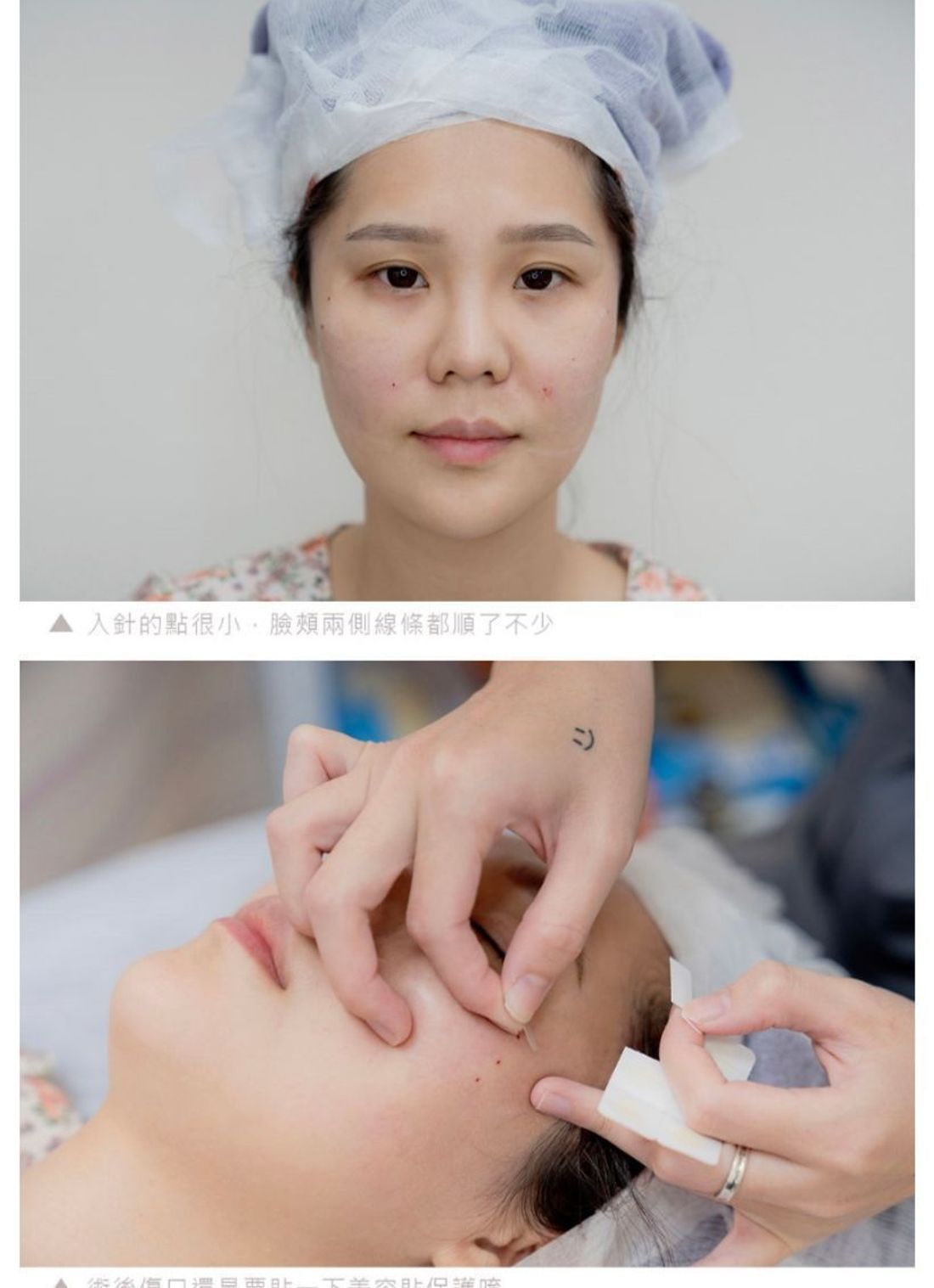 高階抗老 陳裕豪醫師 | 高階止痛技術 微創筋膜重建抗老拉提