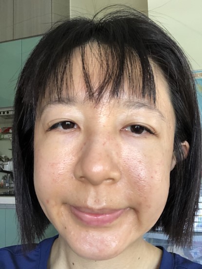 高階抗老 陳裕豪醫師 | 雞尾酒技術除斑抗老