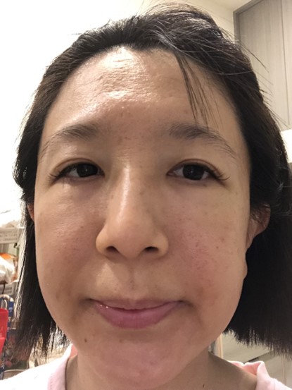 高階抗老 陳裕豪醫師 | 雞尾酒技術除斑抗老