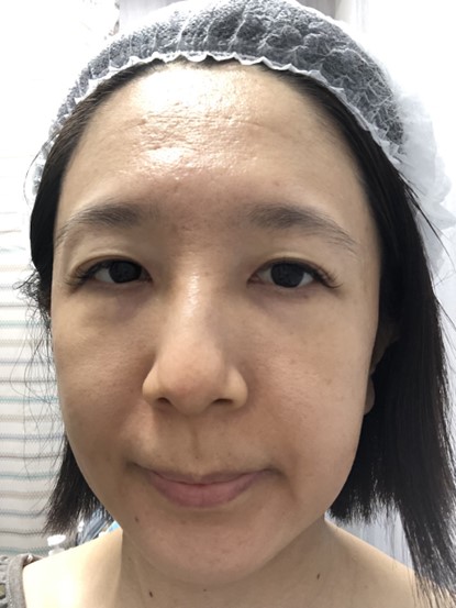 高階抗老 陳裕豪醫師 | 雞尾酒技術除斑抗老