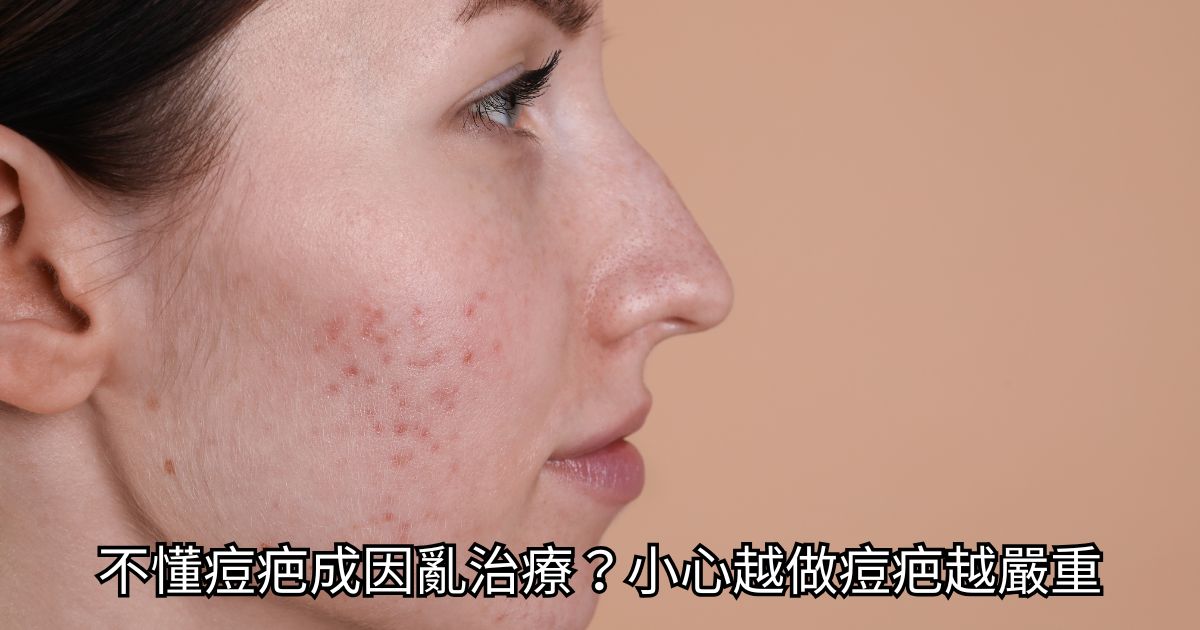 高階抗老 陳裕豪醫師 3段式組織重建痘疤治療