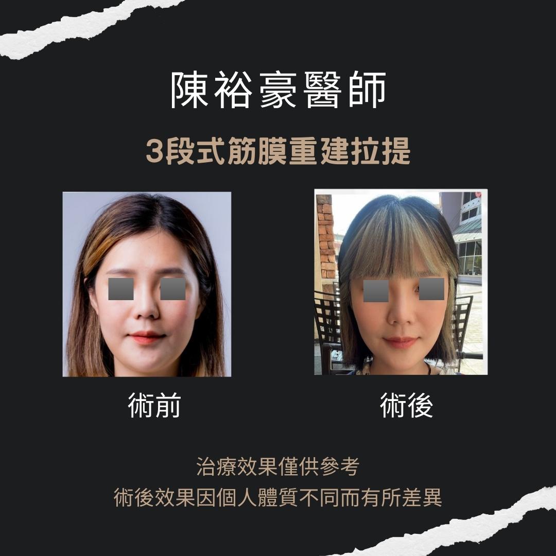 高階抗老陳裕豪醫師 無痛筋膜重建抗老拉提