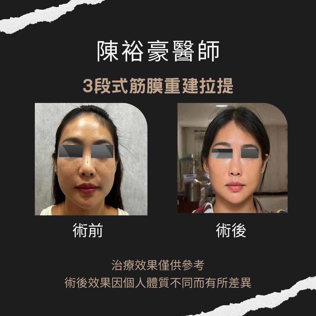 高階抗老陳裕豪醫師 無痛筋膜重建抗老拉提