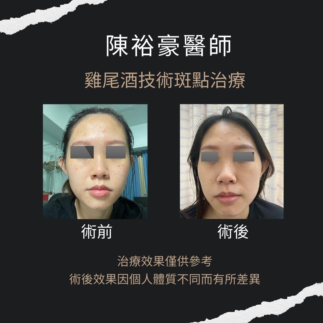 高階抗老 陳裕豪醫師 | 雞尾酒技術除斑抗老