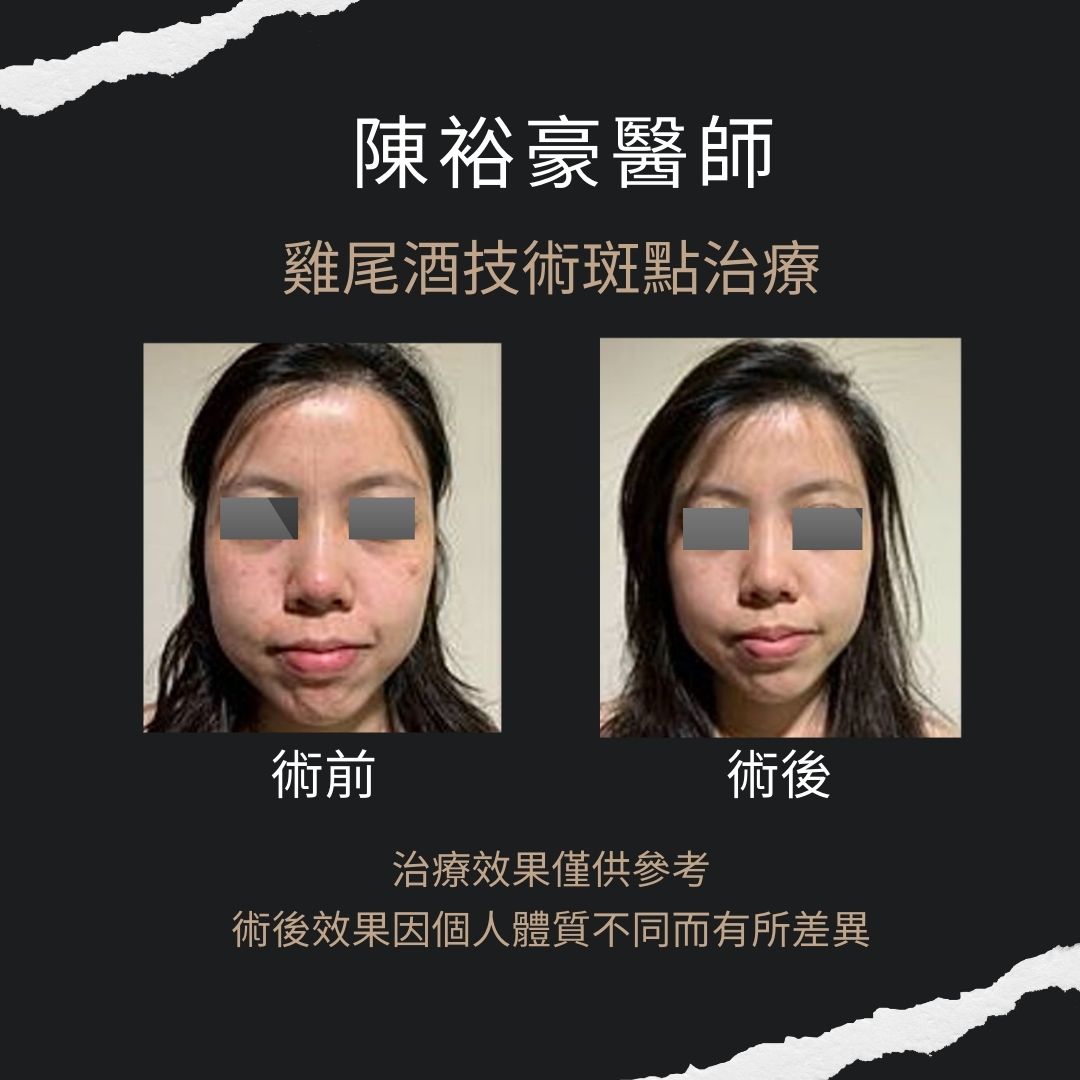 高階抗老 陳裕豪醫師 | 雞尾酒技術除斑抗老