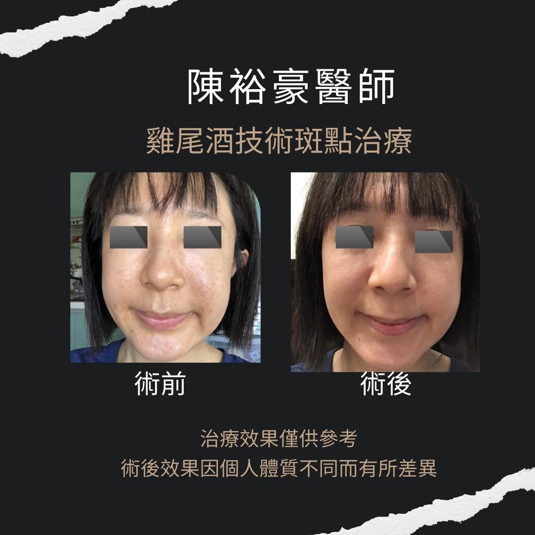 高階抗老 陳裕豪醫師 | 雞尾酒技術除斑抗老